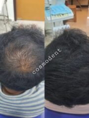GFC, PRP, Hair Growth