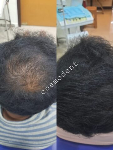 GFC, PRP, Hair Growth