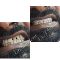 Teeth Alignment